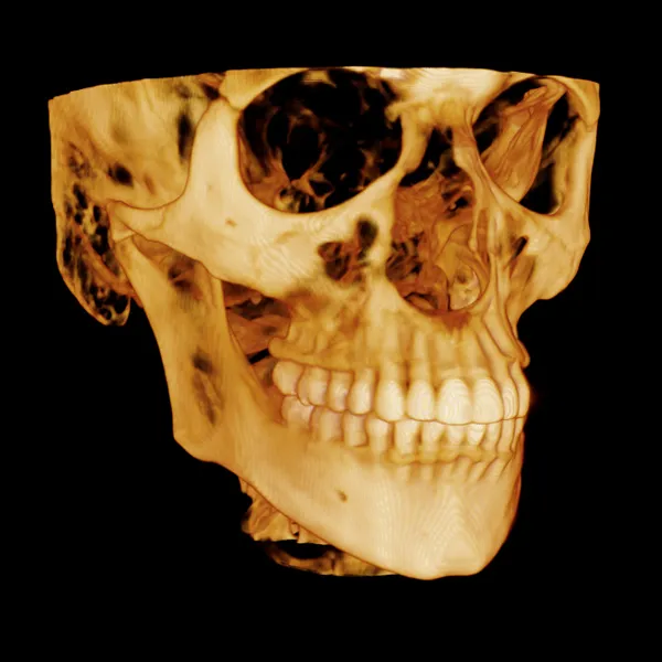 Cone Beam CT scan showing 3D skull with teeth 